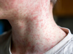 Çocukluk hastalığı geri döndü! Kızamık vakaları korkutuyor