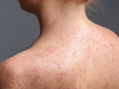 İstanbul’da yeni salgın: Vakalar giderek artıyor! Yetişkinlerde de görülüyor