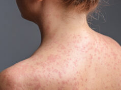 Prof. Dr. Kara’dan kızamık uyarısı! Bir kişi 18 kişiye bulaştırabilir